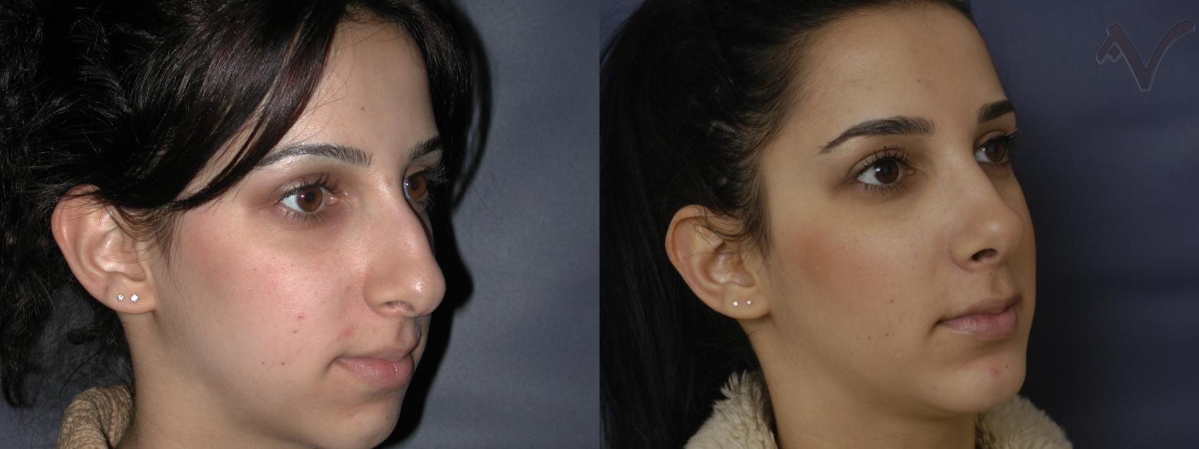 Armen Vartany, MD, FACS: Plastic Surgery and Laser Center chin implant result — Burbank, CA