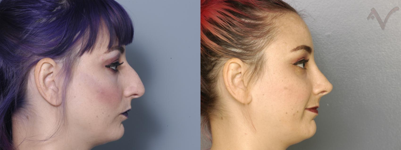 Armen Vartany, MD, FACS: Plastic Surgery and Laser Center rhinoplasty result — Burbank, CA