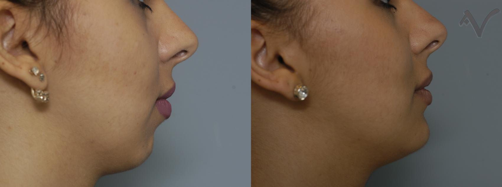 Armen Vartany, MD, FACS: Plastic Surgery and Laser Center chin implant result — Burbank, CA