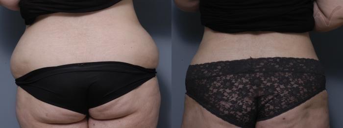 Armen Vartany, MD, FACS: Plastic Surgery and Laser Center liposuction result — Burbank, CA