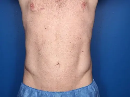 Howland Plastic Surgery liposuction after — Draper, UT