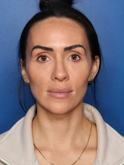 Blepharoplasty after at Howland Plastic Surgery in Draper, UT