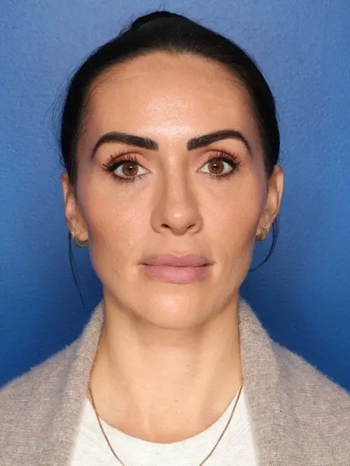 Blepharoplasty before at Howland Plastic Surgery in Draper, UT