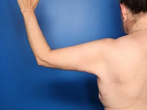 Howland Plastic Surgery body contouring after — Draper, UT