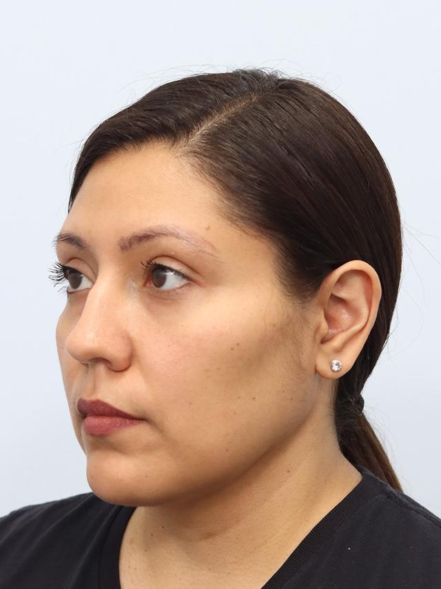 Neck Liposuction after at That Face Facial Plastic Surgery in Chicago, IL