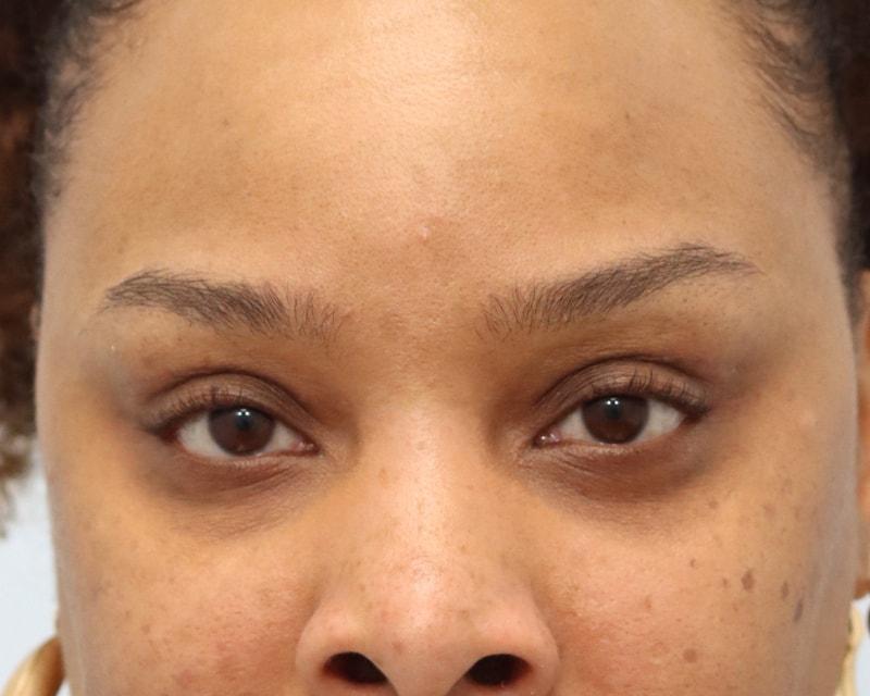 That Face Facial Plastic Surgery eyelid lift after — Chicago, IL