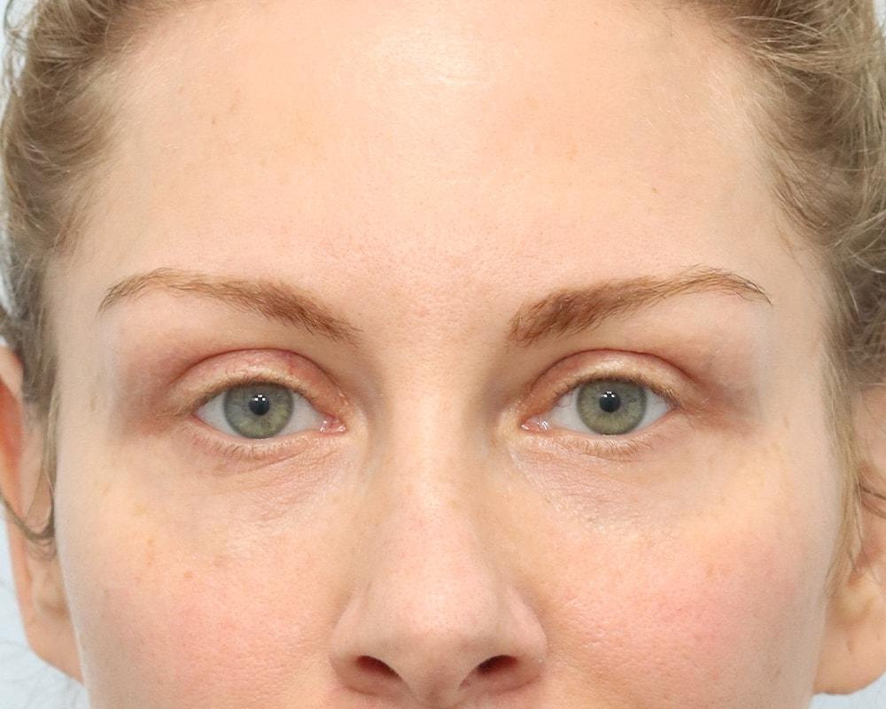 That Face Facial Plastic Surgery eyelid lift after — Chicago, IL