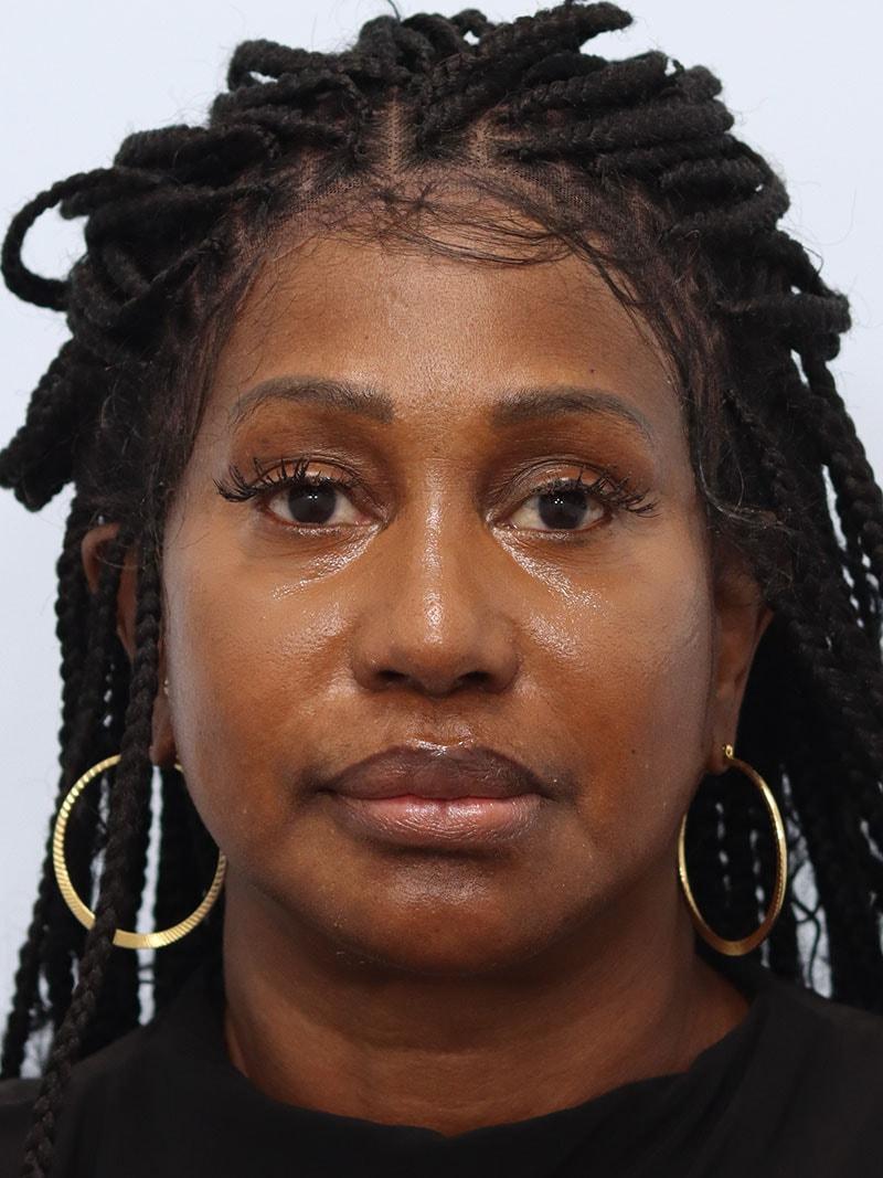 That Face Facial Plastic Surgery jawline filler after — Chicago, IL