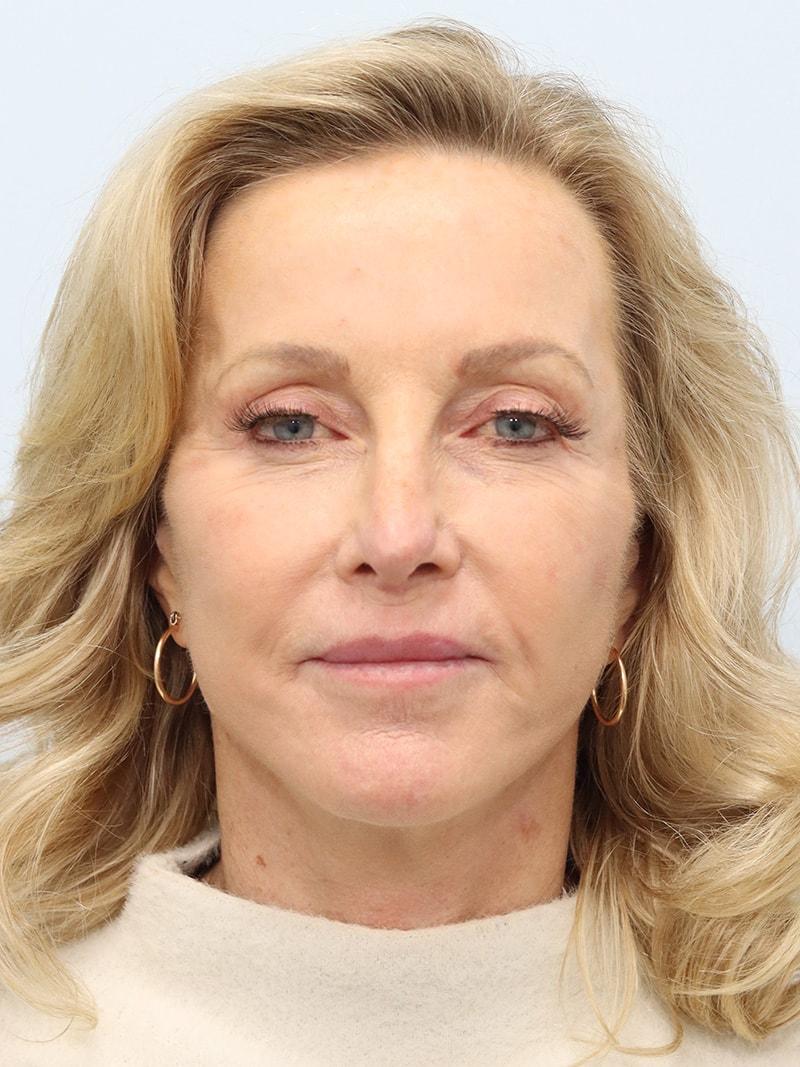 That Face Facial Plastic Surgery facelift after — Chicago, IL