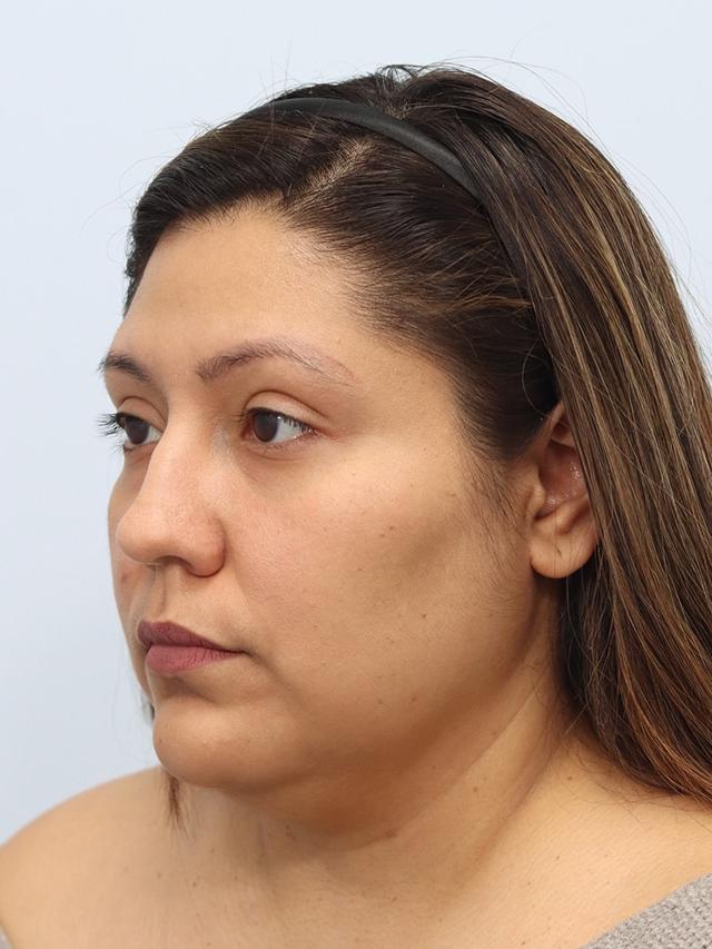Neck Liposuction before at That Face Facial Plastic Surgery in Chicago, IL