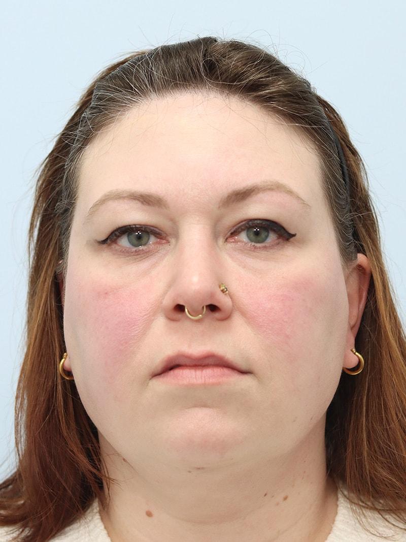 That Face Facial Plastic Surgery facelift after — Chicago, IL
