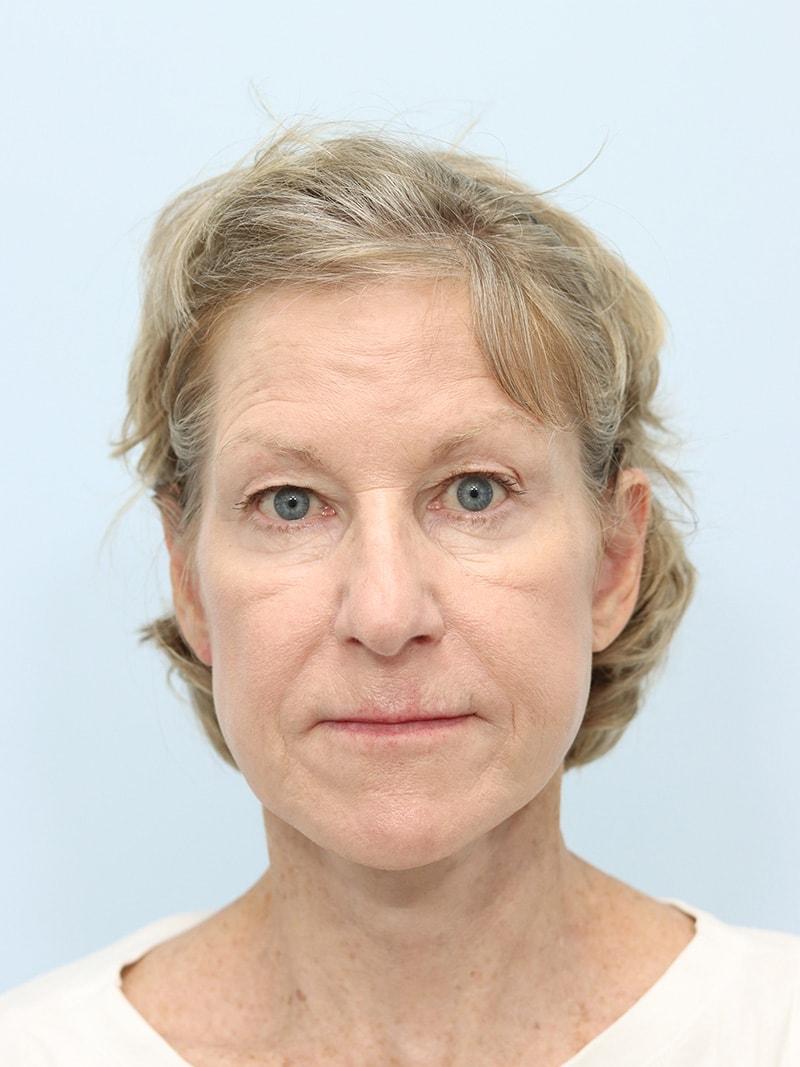 That Face Facial Plastic Surgery facelift after — Chicago, IL