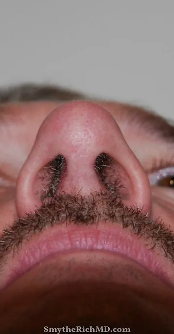 Rhinoplasty after at Rich & Humenansky Plastic Surgery of the Face and Body in Columbia, SC
