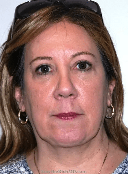 Blepharoplasty after at Rich & Humenansky Plastic Surgery of the Face and Body in Columbia, SC