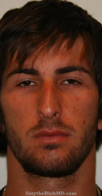 Rhinoplasty before at Rich & Humenansky Plastic Surgery of the Face and Body in Columbia, SC