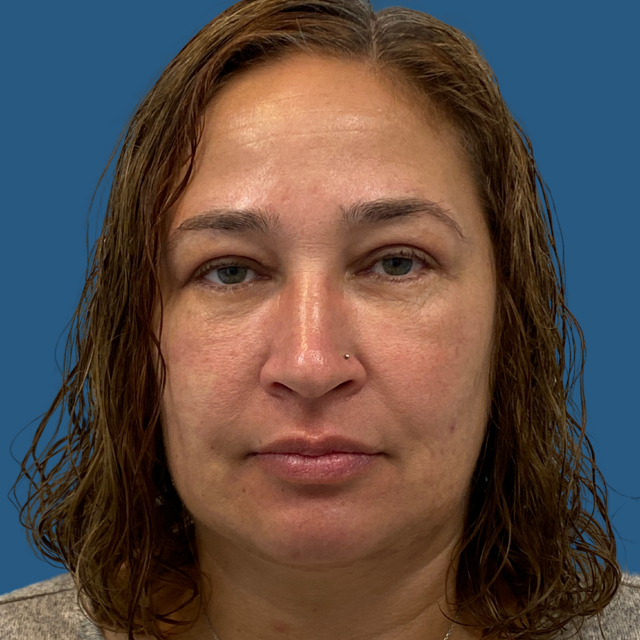 Blepharoplasty after at Rich & Humenansky Plastic Surgery of the Face and Body in Columbia, SC
