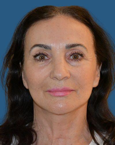 Rich & Humenansky Plastic Surgery of the Face and Body lip filler after — Columbia, SC