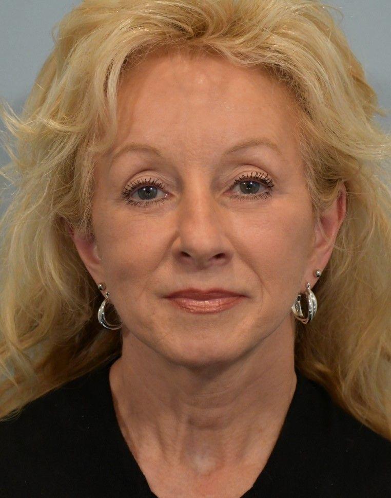 Rich & Humenansky Plastic Surgery of the Face and Body facelift after — Columbia, SC