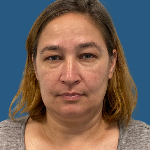 Blepharoplasty before at Rich & Humenansky Plastic Surgery of the Face and Body in Columbia, SC