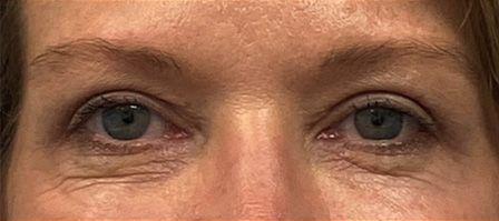 Blepharoplasty after at Rich & Humenansky Plastic Surgery of the Face and Body in Columbia, SC