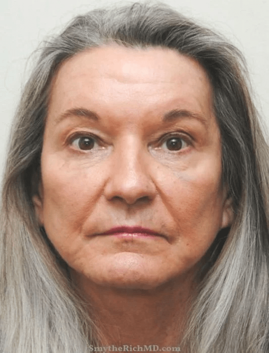 Brow Lift after at Rich & Humenansky Plastic Surgery of the Face and Body in Columbia, SC