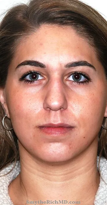 Rhinoplasty before at Rich & Humenansky Plastic Surgery of the Face and Body in Columbia, SC