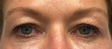 Blepharoplasty before at Rich & Humenansky Plastic Surgery of the Face and Body in Columbia, SC