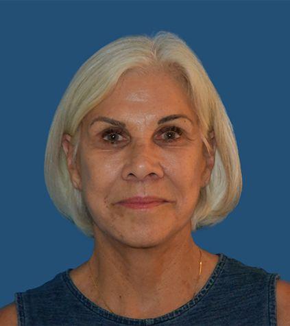 Rich & Humenansky Plastic Surgery of the Face and Body after — Columbia, SC
