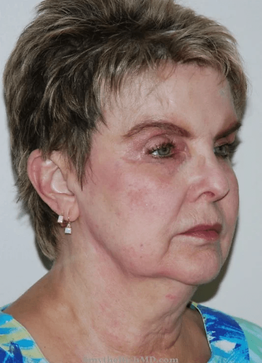 Facelift before at Rich & Humenansky Plastic Surgery of the Face and Body in Columbia, SC