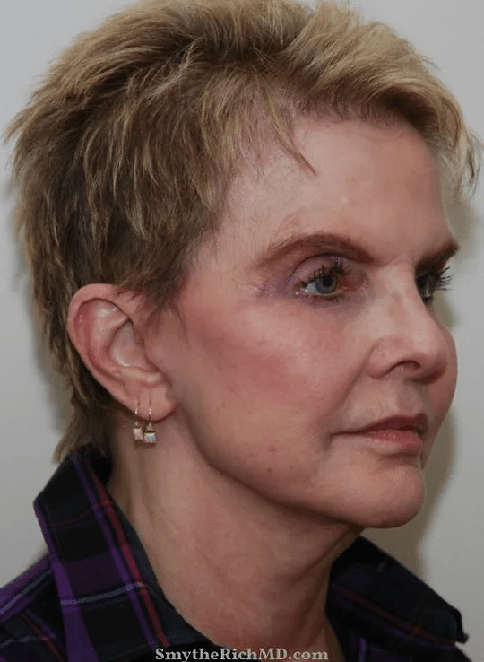 Rich & Humenansky Plastic Surgery of the Face and Body after — Columbia, SC