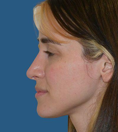 Rhinoplasty after at Rich & Humenansky Plastic Surgery of the Face and Body in Columbia, SC