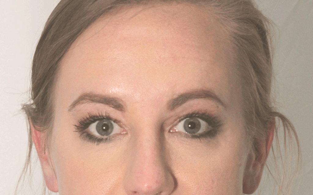 Erica Bartlett, MD eyelid lift after — Katy, TX