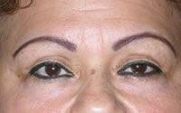 Basil Pakeman, MD eyelid lift after — New York, NY