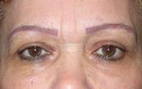 Basil Pakeman, MD eyelid lift after — New York, NY