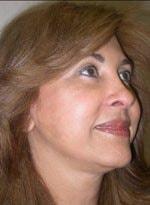 Basil Pakeman, MD facelift after — New York, NY