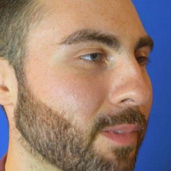 Basil Pakeman, MD buccal fat removal after — New York, NY