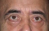 Basil Pakeman, MD eyelid lift after — New York, NY