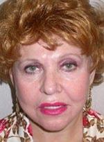 Basil Pakeman, MD facelift after — New York, NY