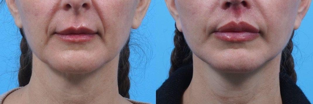 Kismet Iorio Surgical Sculpting lip lift result — Salt Lake City, UT