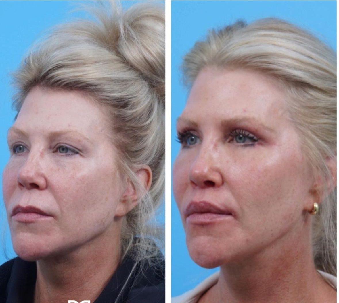 Kismet Iorio Surgical Sculpting eyelid lift result — Salt Lake City, UT