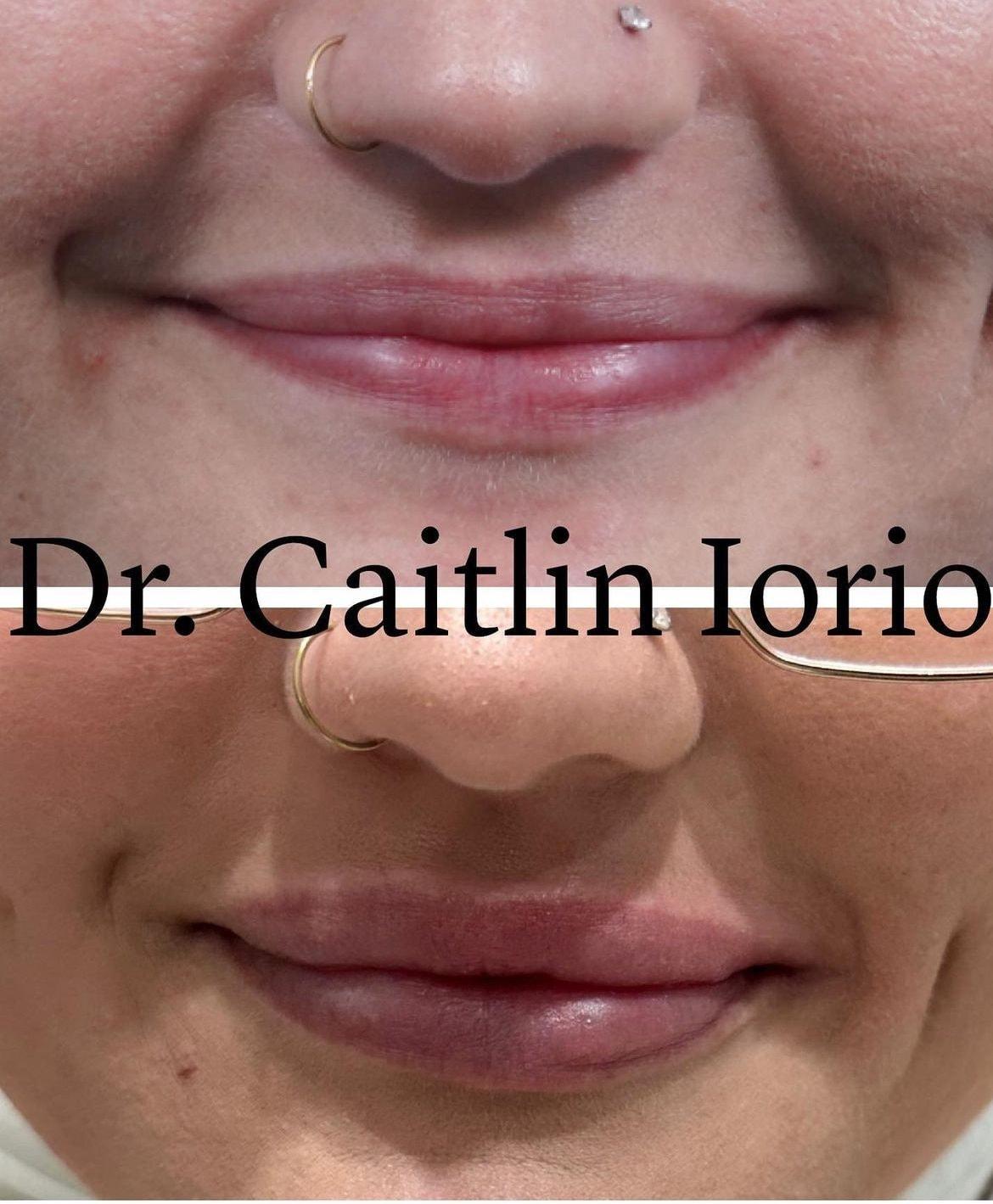 Kismet Iorio Surgical Sculpting lip filler result — Salt Lake City, UT