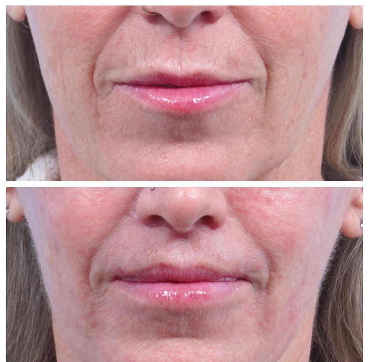 Kismet Iorio Surgical Sculpting lip lift result — Salt Lake City, UT