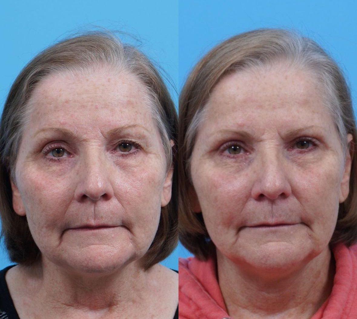 Kismet Iorio Surgical Sculpting eyelid lift result — Salt Lake City, UT