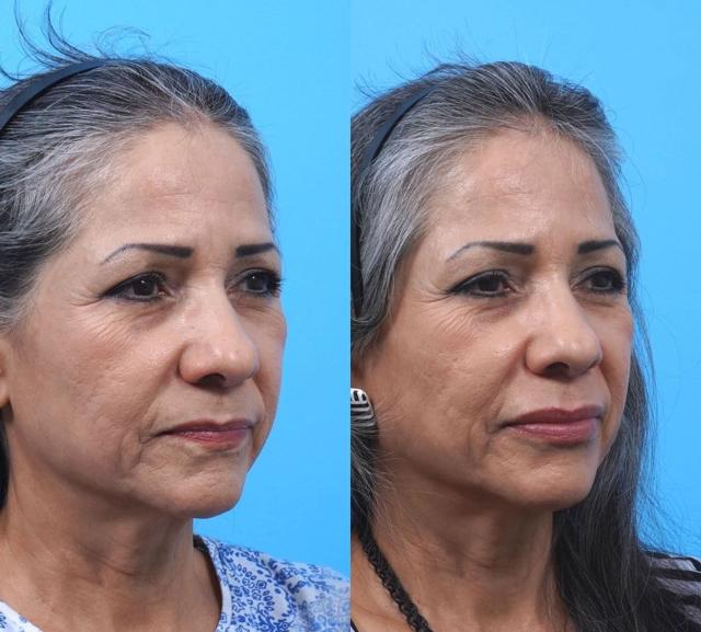 Fat Transfer result at Kismet Iorio Surgical Sculpting in Salt Lake City, UT