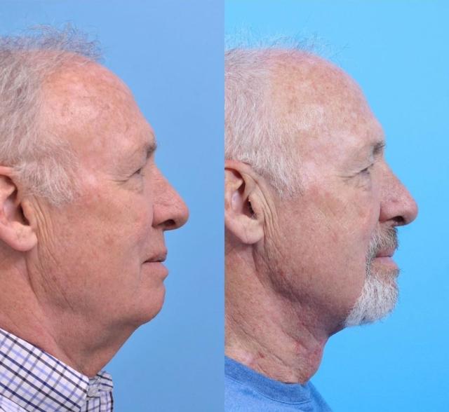 Neck Lift result at Kismet Iorio Surgical Sculpting in Salt Lake City, UT