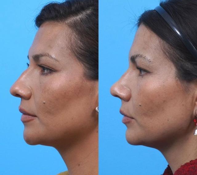 Functional Rhinoplasty result at Kismet Iorio Surgical Sculpting in Salt Lake City, UT