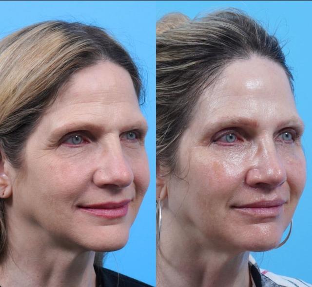 Brow Lift result at Kismet Iorio Surgical Sculpting in Salt Lake City, UT