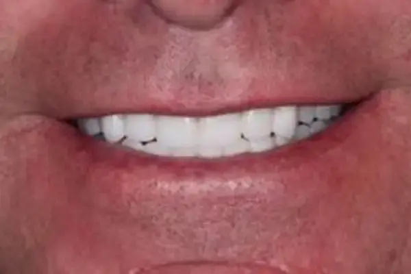 Dental Works smile makeover after — Scottsdale, AZ