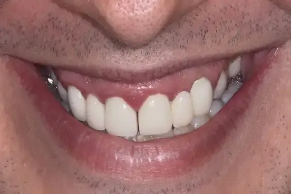 Gum Contouring before at Dental Works in Scottsdale, AZ