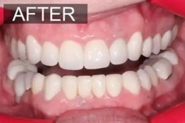 Dental Veneers after at Dental Works in Scottsdale, AZ